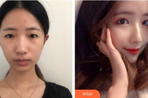 上海和平眼科醫(yī)院沈際穎整形價格表附眼部綜合案例展示