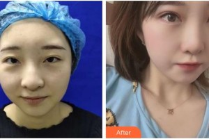 上海?，斎鹨曆劭漆t(yī)院張士勝整形價格表附全切雙眼皮+去皮去脂案例展示