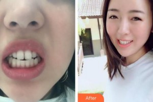 上海維樂口腔門診部沈華整形價格表附門牙擁擠、齙牙案例展示
