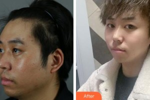 上海紐菲思醫(yī)療美容門診部曾垂紳整形價格表附下頜角整形案例展示