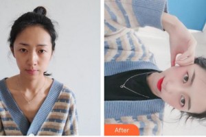 上海萊森醫(yī)療美容門診部王彥坤整形價格表附發(fā)際線種植案例展示