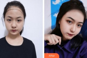 上海萊森醫(yī)療美容門診部李少雄整形價格表附美女發(fā)際線種植案例展示