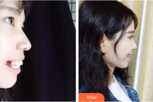 上海伊萊美醫(yī)療美容醫(yī)院陳秀梅整形價格表附齙牙小仙女案例展示