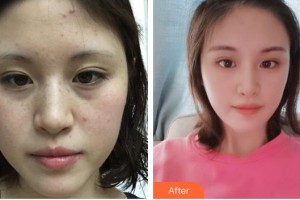 上海御顏醫(yī)療美容門診部張偉整形價(jià)格表附祛斑案例展示