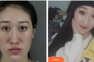 上海南山醫(yī)院美容外科盧立新整形價(jià)格表附神奇的雙顎畸形矯正術(shù)案例展示