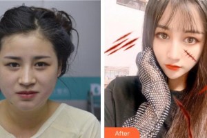 上海南山醫(yī)院美容外科管彩娣整形價(jià)格表附面部吸脂案例展示