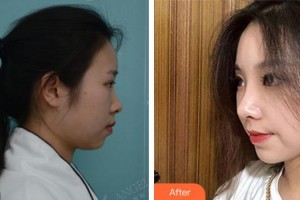 上海麗園醫(yī)療美容門診部陳海珍整形價(jià)格表附鼻部手術(shù)|打造精致自然翹鼻案例展示