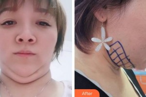 上海麗質(zhì)整形美容醫(yī)院高冠云整形價(jià)格表附面部輪廓案例展示