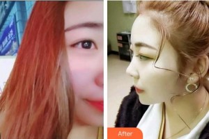 上海知音醫(yī)院醫(yī)療美容科韓沒問題整形價(jià)格表附超聲波潔牙案例展示