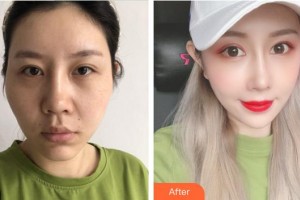 上海馨美醫(yī)療美容門診部錢鋆整形價(jià)格表附面部吸脂案例展示