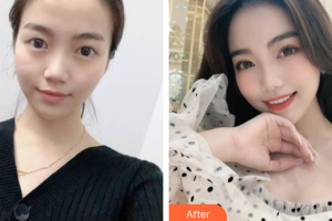 上海昕伊顏醫(yī)療美容醫(yī)院吳躍整形價(jià)格表附切開雙眼皮+內(nèi)眼角案例展示