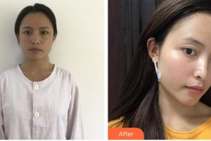 上海歐萊美醫(yī)療美容醫(yī)院楊書彬整形價(jià)格表附面部吸脂案例展示