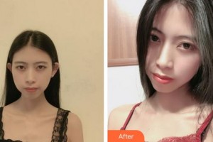 上海愛爾麗醫(yī)療美容門診部蘇愉婕整形價格表附微針美白嫩膚縮小毛孔案例展示