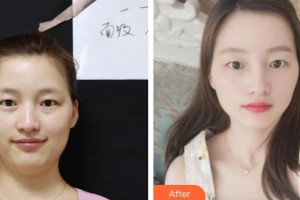 上海天美醫(yī)療美容醫(yī)院安迪整形價格表附面部光纖吸脂案例展示