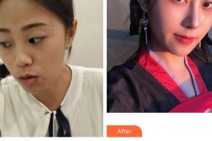 上海悅?cè)R醫(yī)療美容門診部李醫(yī)生整形價(jià)格表附耳軟骨隆鼻案例展示