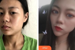 上海柏薈醫(yī)療美容門診部周明書整形價格表附洛麗塔美眼案例展示