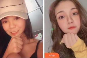 上海柏薈醫(yī)療美容門診部彭賢禮整形價(jià)格表附玻尿酸導(dǎo)入案例展示