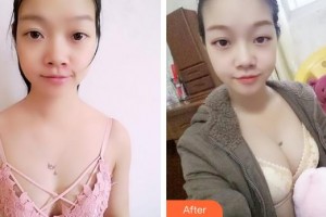 成都美立方（原華博）醫(yī)療美容醫(yī)院王強(qiáng)整形價(jià)格表附隆胸案例展示