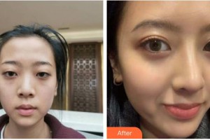 成都藝星醫(yī)療美容醫(yī)院蔡靈整形價(jià)格表附半肋鼻部手術(shù)案例展示