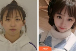 成都美立方（原華博）醫(yī)療美容醫(yī)院黃華整形價(jià)格表附面部吸脂案例展示