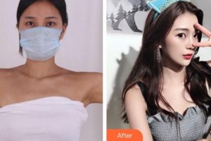 成都市第三人民醫(yī)院醫(yī)學(xué)整形美容科梁靜萍整形價(jià)格表附手臂吸脂案例展示