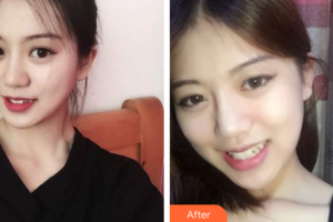 廣州星團(tuán)醫(yī)學(xué)美容門診部邱煥標(biāo)整形價格表附面部輪廓案例展示