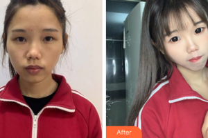 廣州廣美整形美容醫(yī)院王國權(quán)整形價格表附面部吸脂案例展示