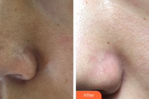 廣州曙光醫(yī)學(xué)美容醫(yī)院鐘金源整形價格表附水氧活膚案例展示