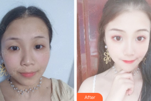 廣州華美醫(yī)療美容醫(yī)院王洪勇整形價格表附無針?biāo)獍咐故?>
</a>
<h3 class=