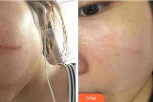 廣州時光整形美容醫(yī)院林麗娜整形價格表附點陣祛疤痕案例展示