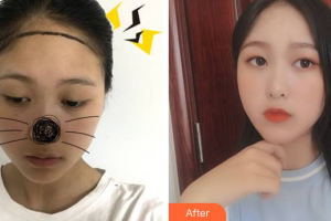 廣州荔醫(yī)醫(yī)療美容門診部何凱強(qiáng)整形價格表附發(fā)際線案例展示