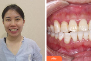 廣州華美醫(yī)療美容醫(yī)院李可君整形價格表附牙齒矯正案例展示