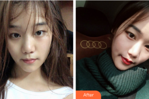 廣州美萊醫(yī)療美容醫(yī)院楊小紅 整形價格表附光子嫩膚案例展示