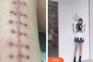 廣州市紅十字會(huì)醫(yī)院燒傷整形科李葉揚(yáng)整形價(jià)格表附微創(chuàng)疤痕修復(fù)案例展示