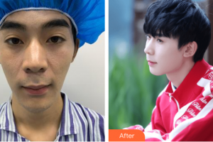 廣州博仕整形美容醫(yī)院朱曉春整形價(jià)格表附鼻部手術(shù)案例展示