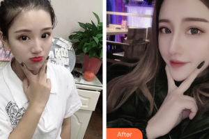 廣州南珠醫(yī)療美容門診部王晉煌整形價(jià)格表附鼻部手術(shù)案例展示