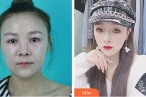 成都漢密爾頓美容醫(yī)院金世泳整形價(jià)格表附鼻部綜合案例展示