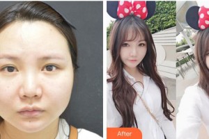 成都少城醫(yī)院醫(yī)療美容科姜元景（KANG WON KYUNG）教授整形價格表附面部輪廓案例展示