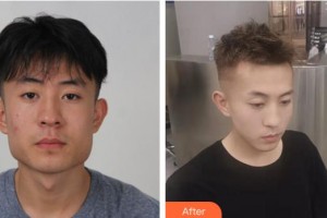 成都少城醫(yī)院醫(yī)療美容科崔熙允（CHOI HEE YOUN）教授整形價格表附頜面整形案例展示