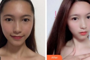 成都少城醫(yī)院植發(fā)科程宗玉整形價格表附發(fā)際線案例展示