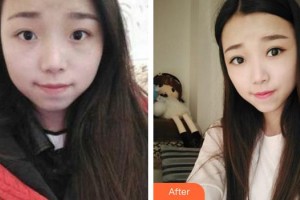 成都百齡駐顏醫(yī)學美容門診部劉寧整形價格表附眼部手術案例展示