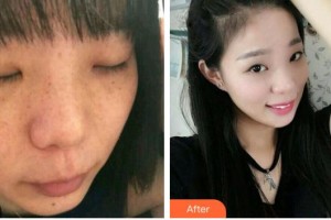 成都華西保健醫(yī)院整形美容中心馬德強整形價格表附雙機祛斑案例展示