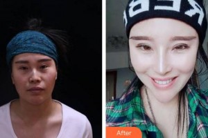 成都華西保健醫(yī)院整形美容中心馬樹林整形價格表附鼻部手術案例展示