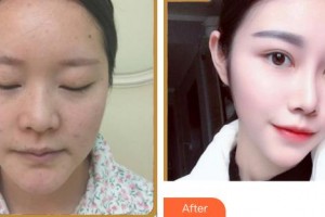 成都華西保健醫(yī)院整形美容中心王先松整形價格表附鼻部多項案例展示