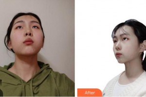 成都漢密爾頓美容醫(yī)院Bitter整形價格表附光子嫩膚案例展示