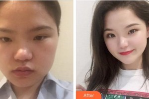 成都艾尚醫(yī)學美容門診部王濤整形價格表附發(fā)際線種植案例展示