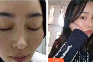 成都艾尚醫(yī)學(xué)美容門(mén)診部張桂林整形價(jià)格表附祛斑案例展示