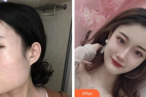 成都艾尚醫(yī)學(xué)美容門(mén)診部高亮整形價(jià)格表附下頜角整形案例展示