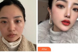 成都風(fēng)尚格致醫(yī)學(xué)美容整形醫(yī)院王曉斌整形價(jià)格表附顴骨+下頜角案例展示