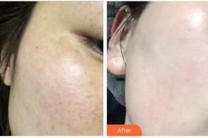 成都艾尚醫(yī)學(xué)美容門(mén)診部傅曉蓉整形價(jià)格表附光子嫩膚祛色斑案例展示